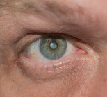 קטרקט: כשהראייה מזדקנת-תמונה